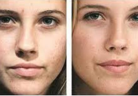 Peeling mixte (AHA/BHA)