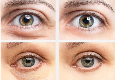 What causes dark circles?