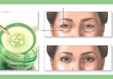 J'ai des poches sous les yeux. Que faire?