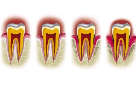 Teeth file > Tartar Buildup