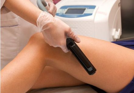 Laser hair removal