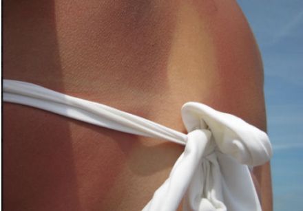 Myths about the sun - A sunburn leaves no damage on the skin. True or false?