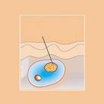 What is cellulite or orange peel skin? 1